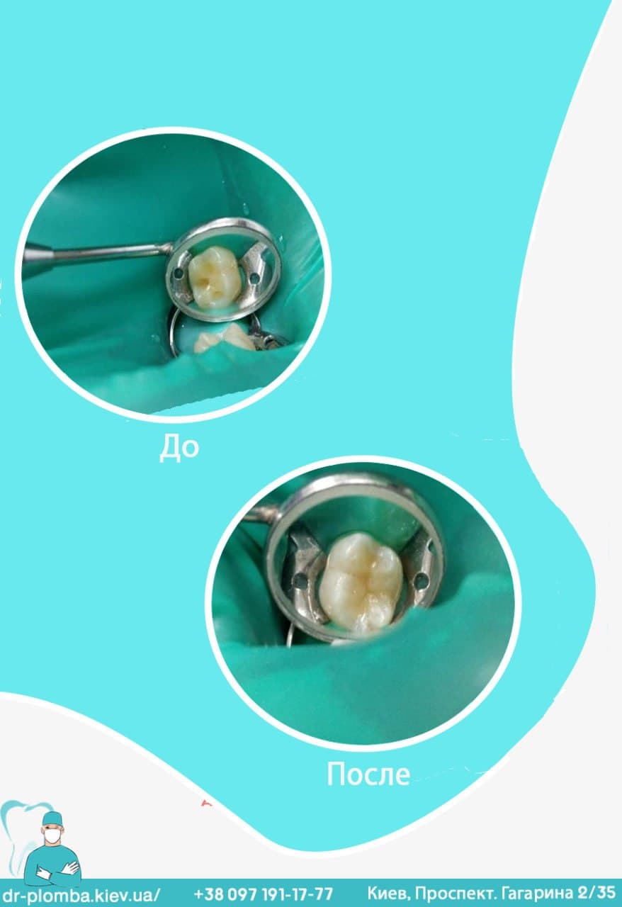 Пломба фотополімерна